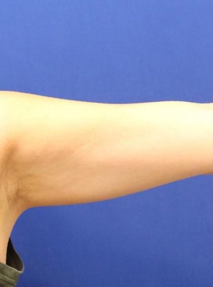 Body Contouring Before & After Patient #14234