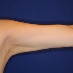 Body Contouring Before & After Patient #14234