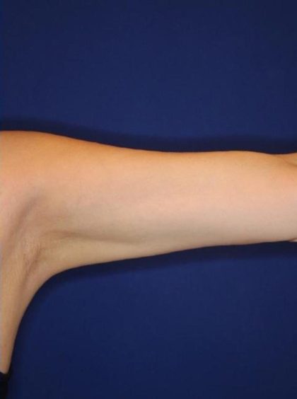 Body Contouring Before & After Patient #14234