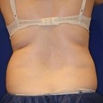 Body Contouring Before & After Patient #14235