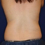 Body Contouring Before & After Patient #14235