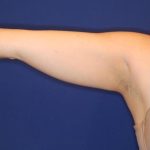 Body Contouring Before & After Patient #14237