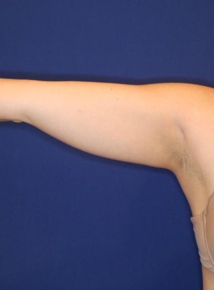 Body Contouring Before & After Patient #14237