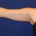 Body Contouring Before & After Patient #14237