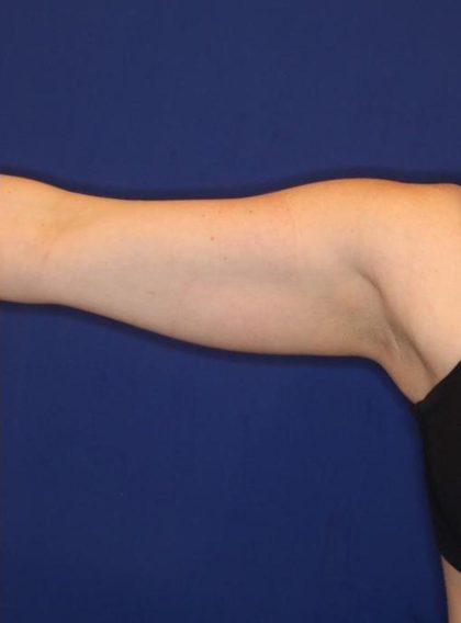 Body Contouring Before & After Patient #14237