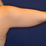 Body Contouring Before & After Patient #14237