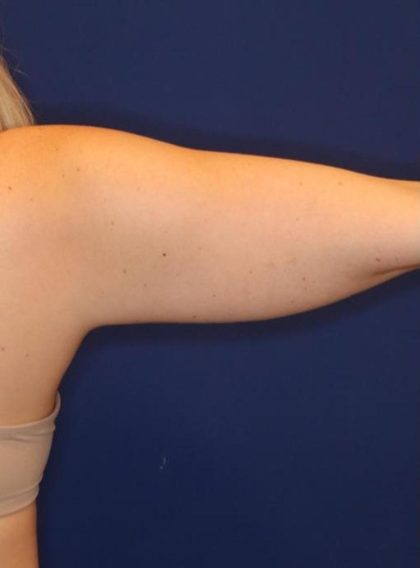 Body Contouring Before & After Patient #14237