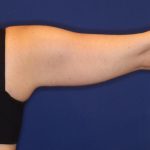 Body Contouring Before & After Patient #14237