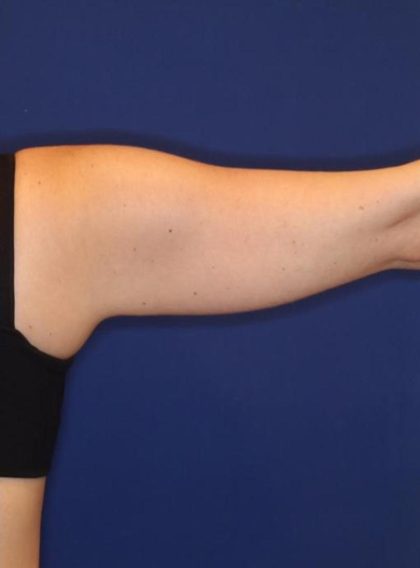 Body Contouring Before & After Patient #14237