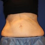 Body Contouring Before & After Patient #14238