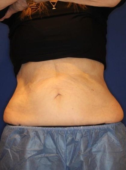 Body Contouring Before & After Patient #14238