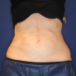 Body Contouring Before & After Patient #14238