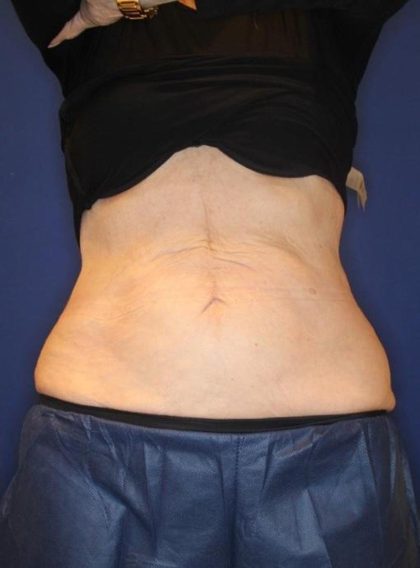 Body Contouring Before & After Patient #14238