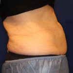 Body Contouring Before & After Patient #14238