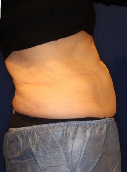 Body Contouring Before & After Patient #14238