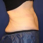 Body Contouring Before & After Patient #14238