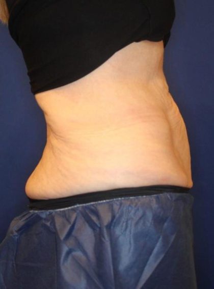 Body Contouring Before & After Patient #14238