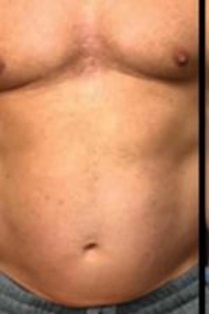 Body Contouring Before & After Patient #14239