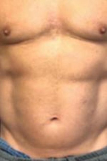 Body Contouring Before & After Patient #14239