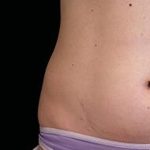 Body Contouring Before & After Patient #14240
