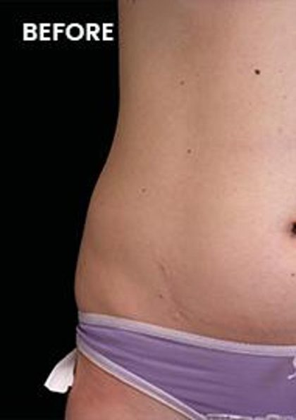 Body Contouring Before & After Patient #14240