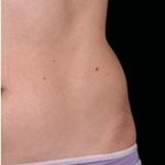 Body Contouring Before & After Patient #14240