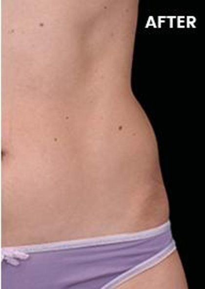 Body Contouring Before & After Patient #14240