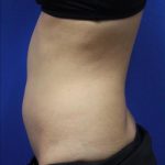 Body Contouring Before & After Patient #14241