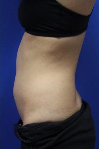 Body Contouring Before & After Patient #14241