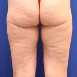 Body Contouring Before & After Patient #14224