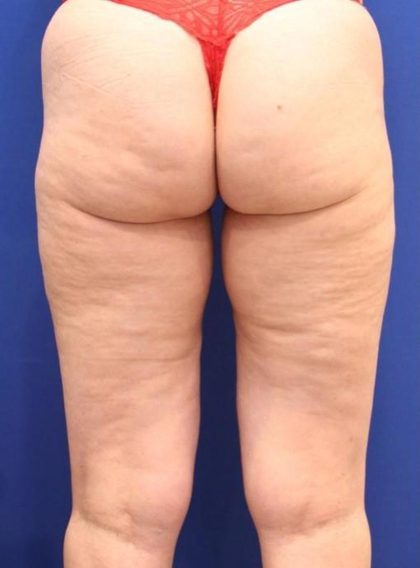 Body Contouring Before & After Patient #14224