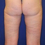 Body Contouring Before & After Patient #14224