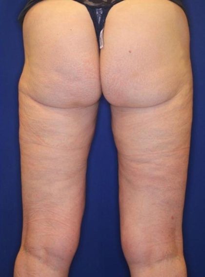 Body Contouring Before & After Patient #14224