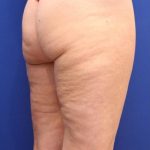 Body Contouring Before & After Patient #14224