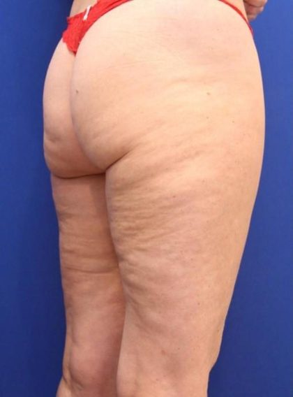 Body Contouring Before & After Patient #14224