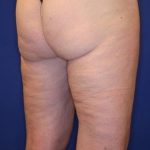 Body Contouring Before & After Patient #14224