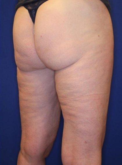 Body Contouring Before & After Patient #14224