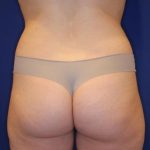 Body Contouring Before & After Patient #14225