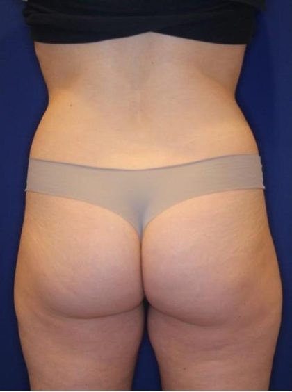 Body Contouring Before & After Patient #14225
