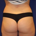 Body Contouring Before & After Patient #14225