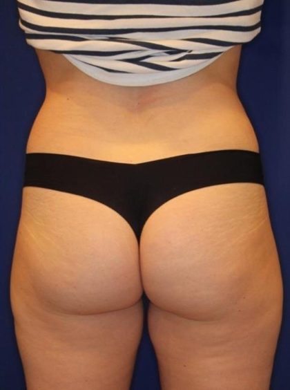 Body Contouring Before & After Patient #14225