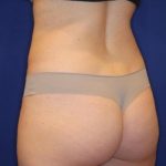 Body Contouring Before & After Patient #14225