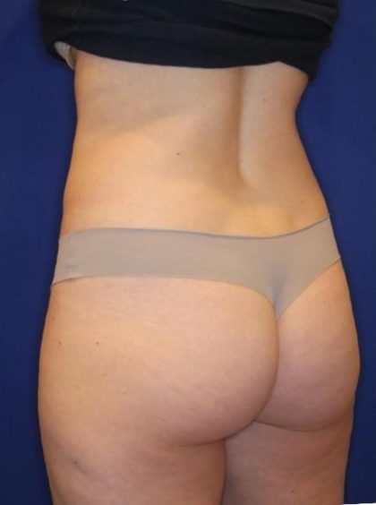 Body Contouring Before & After Patient #14225