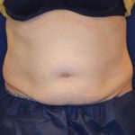 Body Contouring Before & After Patient #14226
