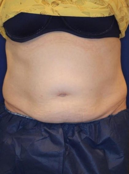 Body Contouring Before & After Patient #14226