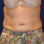Body Contouring Before & After Patient #14226