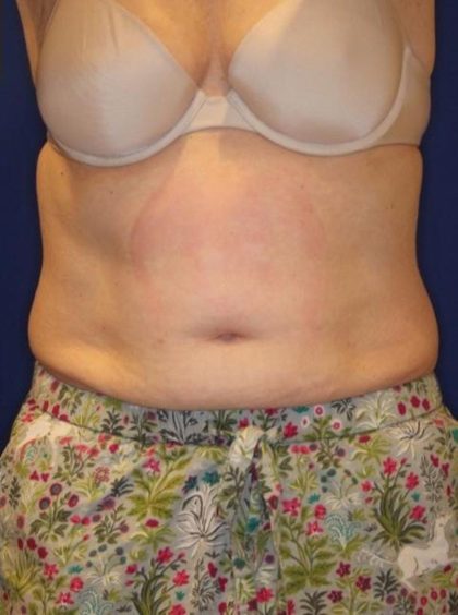 Body Contouring Before & After Patient #14226
