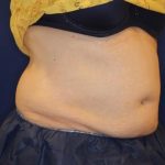 Body Contouring Before & After Patient #14226