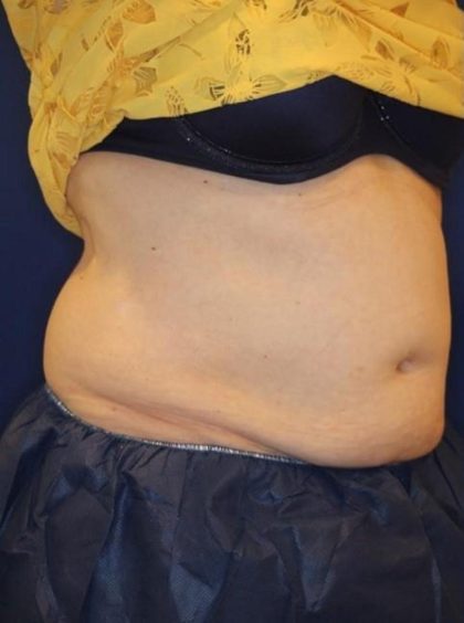 Body Contouring Before & After Patient #14226