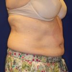 Body Contouring Before & After Patient #14226